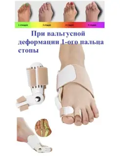 Отводящий корректор первого пальца при hallux valgus