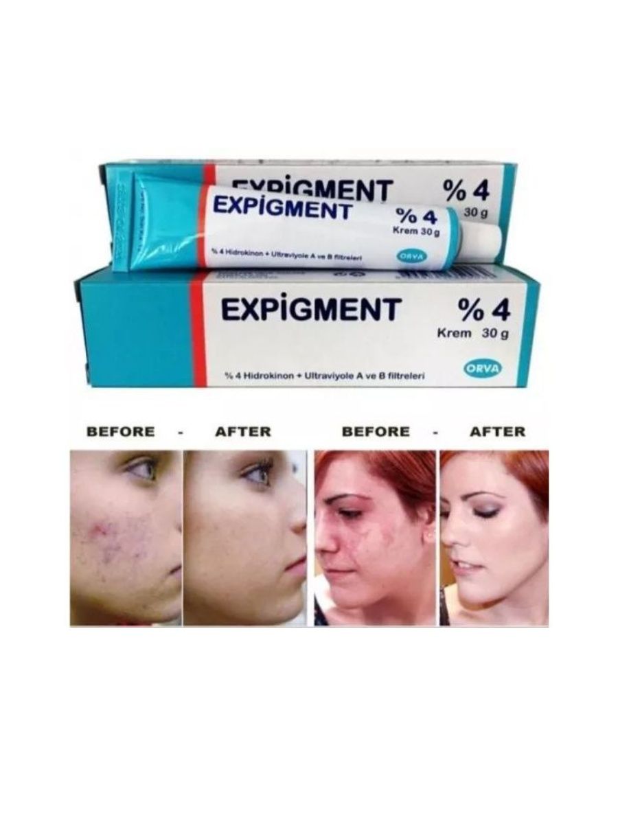 Крем expigment 4 инструкция. Турецкий отбеливающий крем expigment. Expigment 4. Мазь expigment 4. Expigment 4% крем для лица отбеливающий.